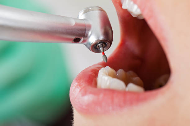 Best Emergency Dentist for Lost Fillings or Crowns in Avon Lake, OH